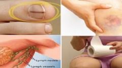 İşte Kadınlarda Göz Ardı Edilen Kanser Belirtileri…! Erken Teşhis Önemlidir..