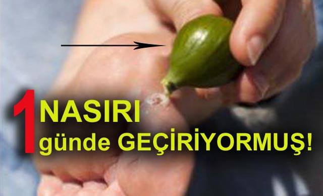 Nasırı 1 Günde Geçirecek Tedavi Yöntemi