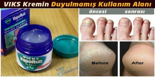 Vicks’in Bilinmeyen Faydaları Ve Kullanım Alanları