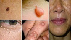 Kahverengi Lekeler Siğiller Ve Diğer Cilt Sorunlarından Bu Mucizevi Karışımlar İle Kurtulun!