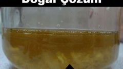 Sedef hastalığına doğal çözüm