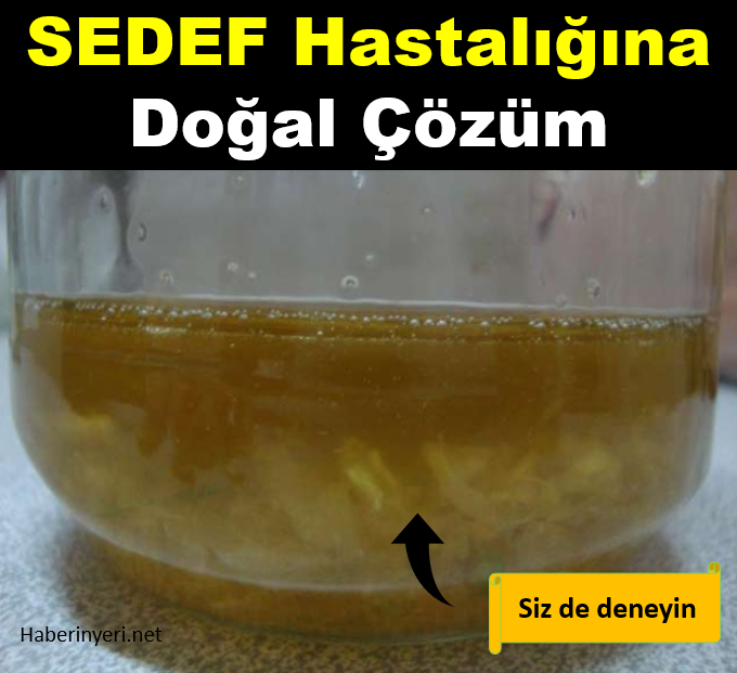 Sedef hastalığına doğal çözüm