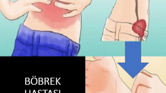 Böbrek Hastalığınız Olduğunun 8 İşareti