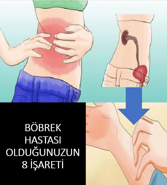 Böbrek Hastalığınız Olduğunun 8 İşareti