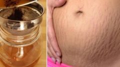 Hamilelikten Kalan Yırtık Derinizden Kurtulun!