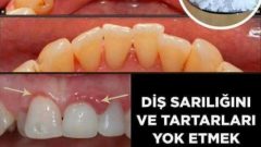 Dişçiye Gitmeden Tartar Temizlemede En Etkili 4 yol