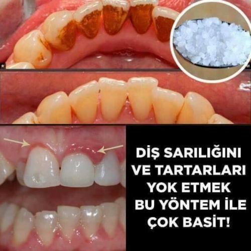 Dişçiye Gitmeden Tartar Temizlemede En Etkili 4 yol