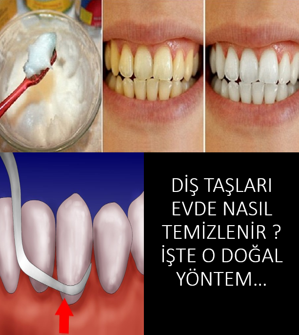 Diş Bakterileri Nasıl Temizlenir?İşte O Doğal Yöntem