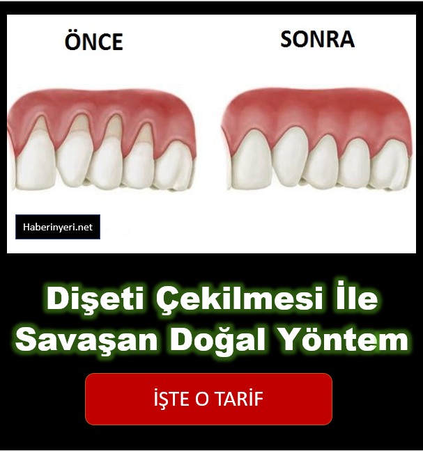 Diş Eti Çekilmesi İle Savaşan Doğal Yöntem