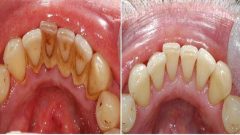 Dişinizdeki Tartardan Kurtulmanız için Mucizevi Tarif