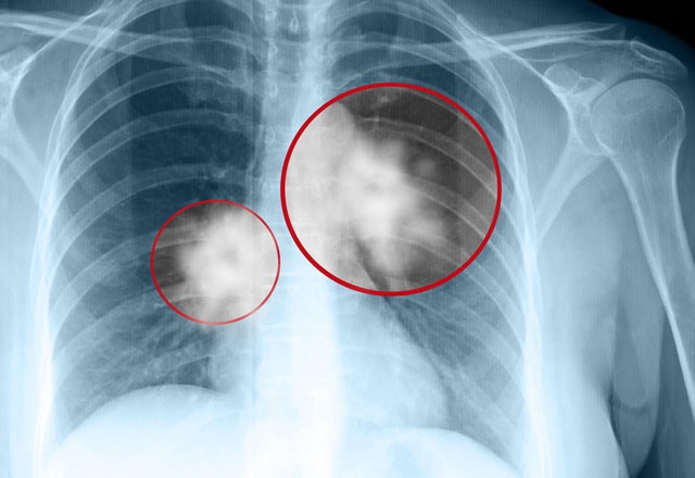 Akciğer kanserini engelleyen kür