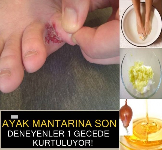 Ayak mantarı hakkında her şey ! Ve kurtulmanın tarifi