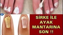 Sirke ile Ayak Mantarına Son! Deneyenler 1 Günde Kurtuluyor…