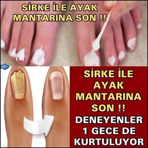 Sirke ile Ayak Mantarına Son! Deneyenler 1 Günde Kurtuluyor...