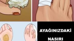 Nasırı Yok Eden Doğal Yöntemler… Nasırdan Evde Kolayca Kurtulun