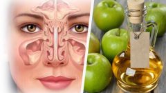 Sinüzitten 5 Günde Nasıl Kurtulursunuz?