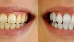 Dişçiye gitmeden tartar temizlemede ve dişleri beyazlatmada en etkili formüller