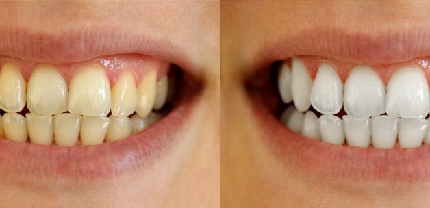 Dişçiye gitmeden tartar temizlemede ve dişleri beyazlatmada en etkili formüller