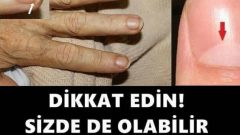 Tırnaklar Hastalığın Aynası Bu Belirtileri Görmezden Gelmeyin