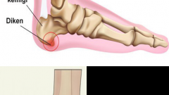Topuk Dikeni için Pulbiberli Bitkisel Tedavi
