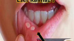 Aft Yaralarına Birebir Sumak