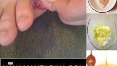 Ayak mantarı hakkında her şey Ve kurtulmanın tarifi