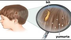 Bu Sırrı Doktorlar Bile Açıklamıyor – İşte Çocuğunuza Geçen Bitten Kurtulmanın Kesin Yöntemi