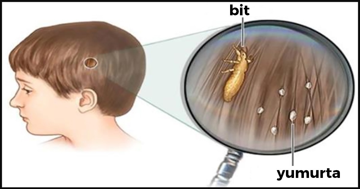 Bu Sırrı Doktorlar Bile Açıklamıyor – İşte Çocuğunuza Geçen Bitten Kurtulmanın Kesin Yöntemi