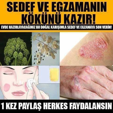 Doğal Sedef ve Egzama Kremi