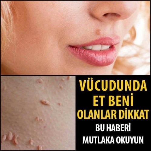 Vücudunda Et Beni Olanlar Dikkat