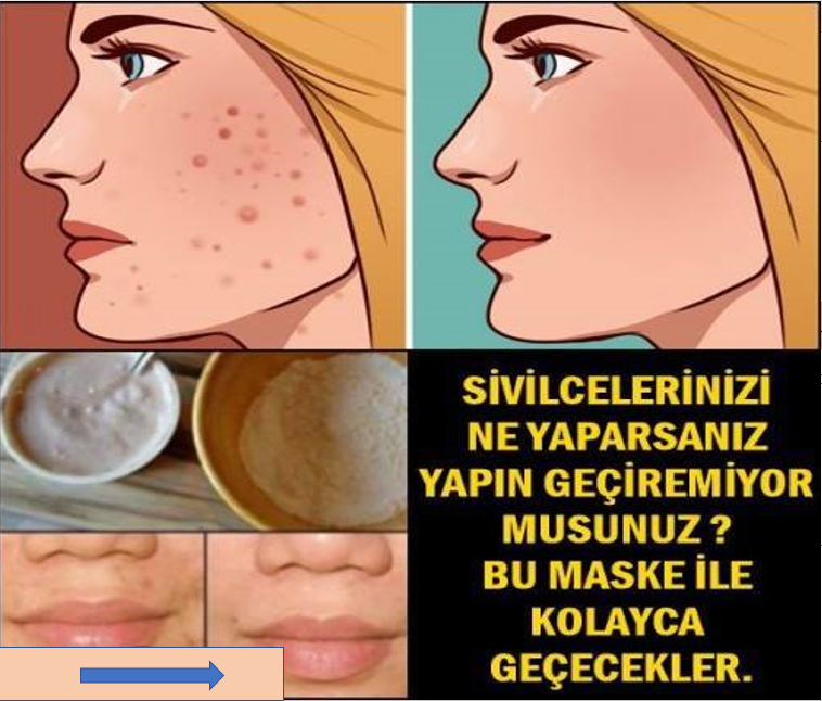 Yüzdeki İstenmeyen Tüyler ve Sivilceler İçin Doğal Maske