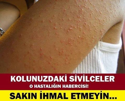 Eğer Sizde de Varsa Hemen Önlemini Alın