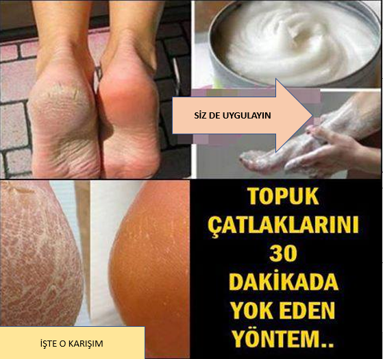 Evde Topuk Çatlaklarını Geçiren Karışım