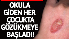 VELİLER DİKKAT! Okula giden bir çok çocukta görünmeye başlandı!