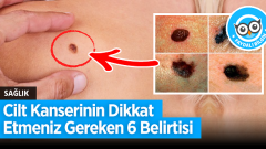 Cilt Kanserinin Dikkat Etmeniz Gereken Belirtileri