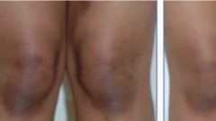 Diz Kapağı Kararmasına Bitkisel Çözümler