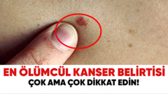İşte en ölümcül kanserin ilk belirtisi
