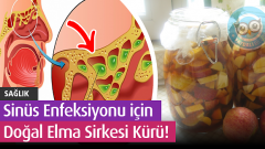 Sinüs Enfeksiyonunu İçin Doğal Elma Sirkesi Kürü