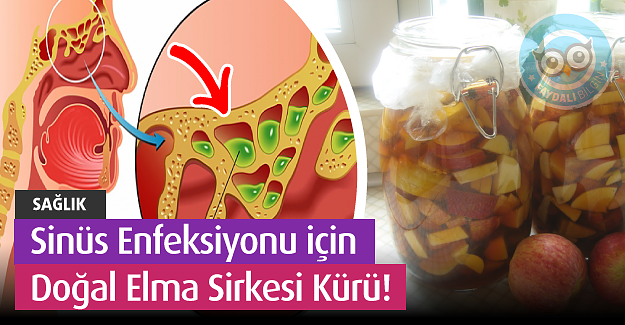 Sinüs Enfeksiyonunu İçin Doğal Elma Sirkesi Kürü