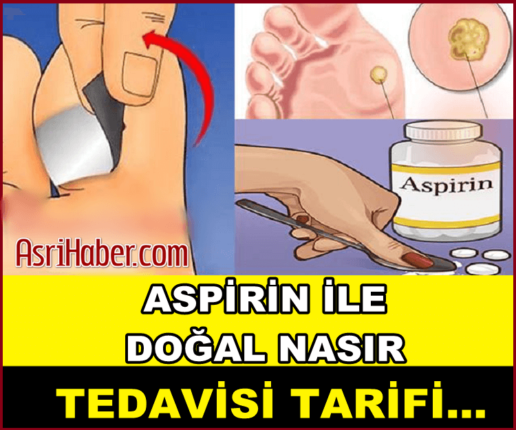 Nasırlardan Kurtulmak için Aspirin Kullanın