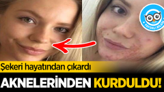 Şekeri Hayatından Çıkardı Tüm Aknelerinden Kurtuldu