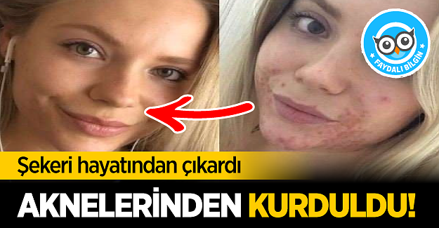 Şekeri Hayatından Çıkardı Tüm Aknelerinden Kurtuldu