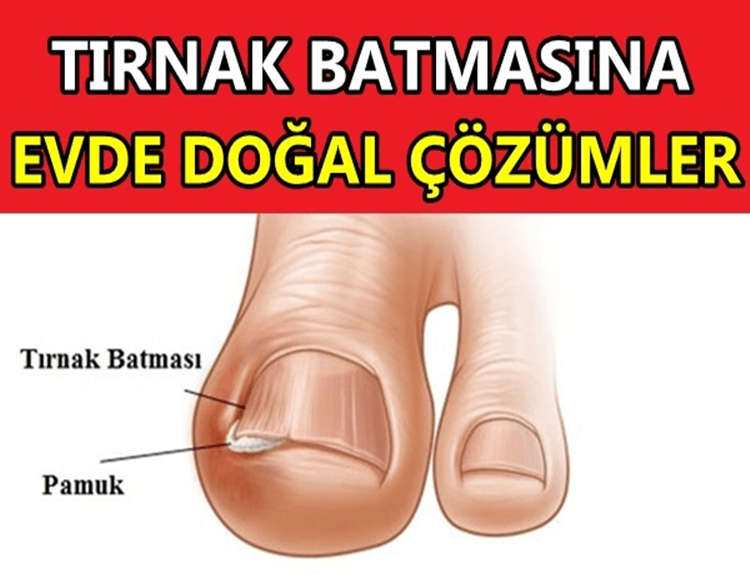 Tırnak Batması Ve Tedavi Yöntemleri