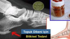 Topuk Dikeni için Pulbiberli Bitkisel Tedavi