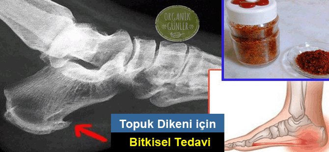 Topuk Dikeni için Pulbiberli Bitkisel Tedavi