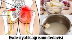 Siyatik ağrısı nasıl geçer Tedavi için doğal kürler