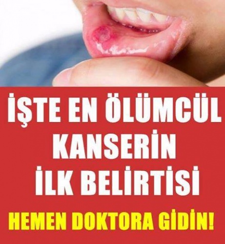 İşte en ölümcül kanserin belirtisi doktora gitmeyi ihmal etmeyin