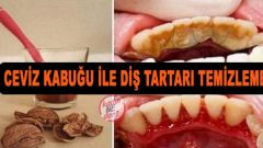 Ceviz Kabuğu İle Diş Tartarı Temizleme