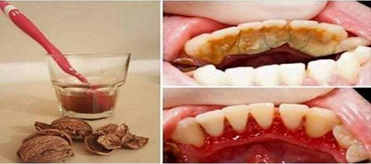 Ceviz Kabuğu İle Diş Tartarı Temizleme