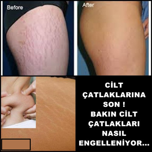 Cilt Çatlaklarına Son Bakın Cilt Çatlaklarını Nasıl Engelliyor